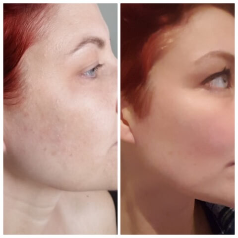 A deep peel with minimal down-time