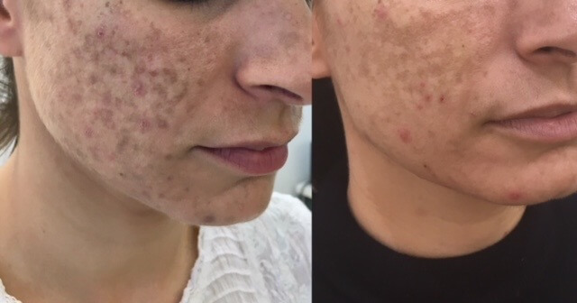 Treating Pigmentation in Acne Skin
