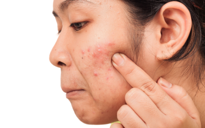 Common Hormonal Imbalances that Cause Acne