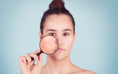 6 Skin Conditions that Look Like Acne But Isn’t Acne