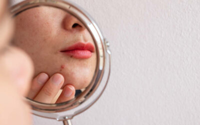 Skin still breaking out as an adult? Here are 8 reasons why your acne is not clearing.